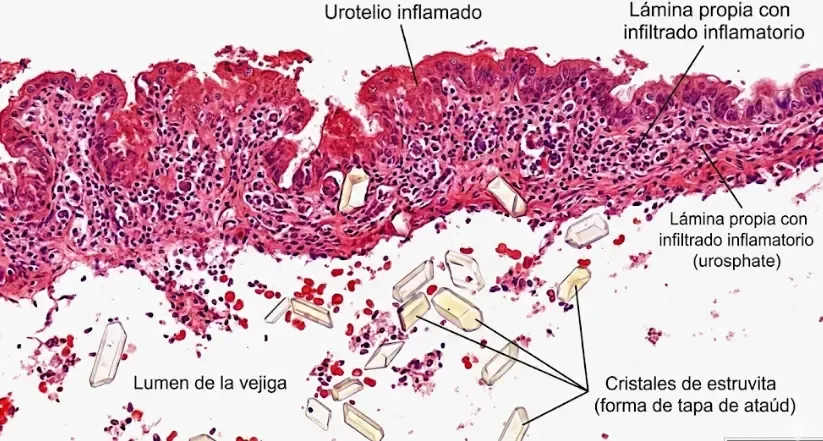 Infografía simple mostrando una vejiga inflamada con cristales de estruvita y un bloqueo uretral